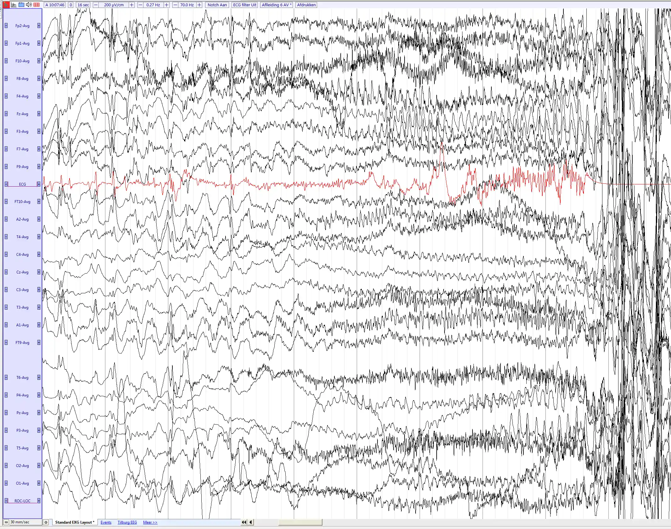 Interpretare EEG